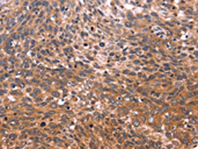 The image on the left is immunohistochemistry of paraffin-embedded Human cervical cancer tissue using CSB-PA165659(GCG Antibody) at dilution 1/20, on the right is treated with synthetic peptide. (Original magnification: ×200)