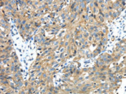The image on the left is immunohistochemistry of paraffin-embedded Human breast cancer tissue using CSB-PA165702(TMPRSS13 Antibody) at dilution 1/30, on the right is treated with fusion protein. (Original magnification: ×200)