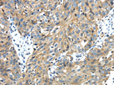 The image on the left is immunohistochemistry of paraffin-embedded Human breast cancer tissue using CSB-PA165702(TMPRSS13 Antibody) at dilution 1/30, on the right is treated with fusion protein. (Original magnification: ×200)