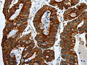 The image on the left is immunohistochemistry of paraffin-embedded Human colon cancer tissue using CSB-PA165755(KRT19 Antibody) at dilution 1/55, on the right is treated with fusion protein. (Original magnification: ×200)