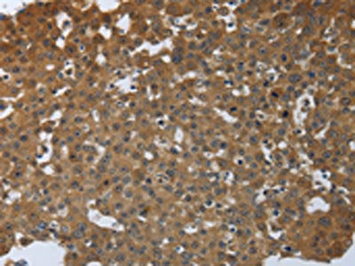The image on the left is immunohistochemistry of paraffin-embedded Human breast cancer tissue using CSB-PA166109(PTPRM Antibody) at dilution 1/40, on the right is treated with synthetic peptide. (Original magnification: ×200)