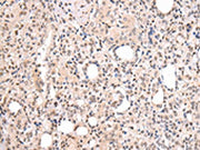 The image on the left is immunohistochemistry of paraffin-embedded Human thyroid cancer tissue using CSB-PA166159(CBX7 Antibody) at dilution 1/20, on the right is treated with synthetic peptide. (Original magnification: ×200)
