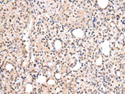 The image on the left is immunohistochemistry of paraffin-embedded Human thyroid cancer tissue using CSB-PA166159(CBX7 Antibody) at dilution 1/20, on the right is treated with synthetic peptide. (Original magnification: ×200)