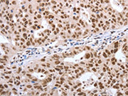 The image on the left is immunohistochemistry of paraffin-embedded Human ovarian cancer tissue using CSB-PA166210(POU3F1 Antibody) at dilution 1/40, on the right is treated with synthetic peptide. (Original magnification: ×200)
