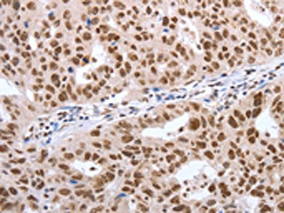 The image on the left is immunohistochemistry of paraffin-embedded Human ovarian cancer tissue using CSB-PA166210(POU3F1 Antibody) at dilution 1/40, on the right is treated with synthetic peptide. (Original magnification: ×200)