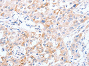 The image on the left is immunohistochemistry of paraffin-embedded Human lung cancer tissue using CSB-PA166219(SCARB1 Antibody) at dilution 1/30, on the right is treated with synthetic peptide. (Original magnification: ×200)
