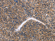 The image on the left is immunohistochemistry of paraffin-embedded Human liver cancer tissue using CSB-PA166299(KLF15 Antibody) at dilution 1/30, on the right is treated with fusion protein. (Original magnification: ×200)