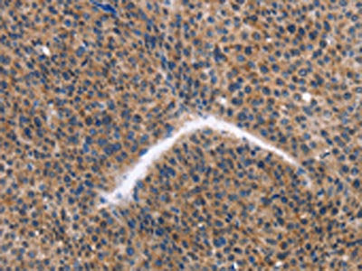 The image on the left is immunohistochemistry of paraffin-embedded Human liver cancer tissue using CSB-PA166299(KLF15 Antibody) at dilution 1/30, on the right is treated with fusion protein. (Original magnification: ×200)