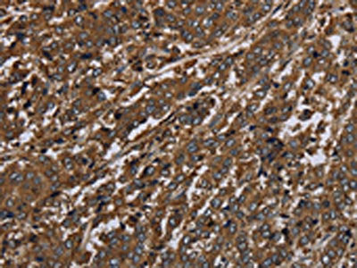 The image on the left is immunohistochemistry of paraffin-embedded Human liver cancer tissue using CSB-PA166476(HPGD Antibody) at dilution 1/30, on the right is treated with fusion protein. (Original magnification: ×200)