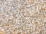 The image on the left is immunohistochemistry of paraffin-embedded Human prostate cancer tissue using CSB-PA166947(SDCBP Antibody) at dilution 1/40, on the right is treated with fusion protein. (Original magnification: ×200)