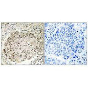 Immunohistochemistry analysis of paraffin-embedded human lung carcinoma tissue using USP36 antibody.