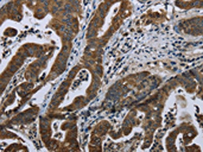The image on the left is immunohistochemistry of paraffin-embedded Human gastic cancer tissue using CSB-PA167353(BRINP1 Antibody) at dilution 1/20, on the right is treated with fusion protein. (Original magnification: ×200)