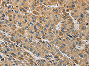 The image on the left is immunohistochemistry of paraffin-embedded Human liver cancer tissue using CSB-PA167583(MIP Antibody) at dilution 1/60, on the right is treated with fusion protein. (Original magnification: ×200)