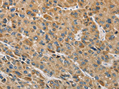 The image on the left is immunohistochemistry of paraffin-embedded Human liver cancer tissue using CSB-PA167583(MIP Antibody) at dilution 1/60, on the right is treated with fusion protein. (Original magnification: ×200)