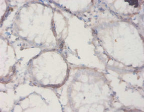 Immunohistochemistry of paraffin-embedded human colon cancer using CSB-PA16769A0Rb at dilution of 1:20