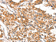 The image on the left is immunohistochemistry of paraffin-embedded Human thyroid cancer tissue using CSB-PA167820(DAB2IP Antibody) at dilution 1/20, on the right is treated with synthetic peptide. (Original magnification: ×200)