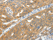 The image on the left is immunohistochemistry of paraffin-embedded Human ovarian cancer tissue using CSB-PA167955(SCN9A Antibody) at dilution 1/40, on the right is treated with synthetic peptide. (Original magnification: ×200)