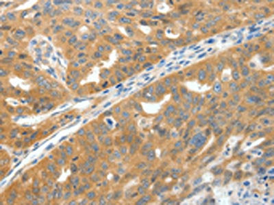 The image on the left is immunohistochemistry of paraffin-embedded Human ovarian cancer tissue using CSB-PA167955(SCN9A Antibody) at dilution 1/40, on the right is treated with synthetic peptide. (Original magnification: ×200)