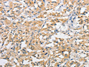 The image on the left is immunohistochemistry of paraffin-embedded Human thyroid cancer tissue using CSB-PA167980(ATG10 Antibody) at dilution 1/60, on the right is treated with fusion protein. (Original magnification: ×200)
