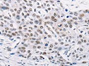 The image on the left is immunohistochemistry of paraffin-embedded Human esophagus cancer tissue using CSB-PA168065(TRIM63 Antibody) at dilution 1/60, on the right is treated with synthetic peptide. (Original magnification: ×200)