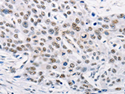 The image on the left is immunohistochemistry of paraffin-embedded Human esophagus cancer tissue using CSB-PA168065(TRIM63 Antibody) at dilution 1/60, on the right is treated with synthetic peptide. (Original magnification: ×200)