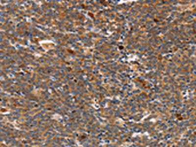 The image on the left is immunohistochemistry of paraffin-embedded Human Lymphoma tissue using CSB-PA168071(STK3/STK4 Antibody) at dilution 1/70, on the right is treated with synthetic peptide. (Original magnification: ×200)