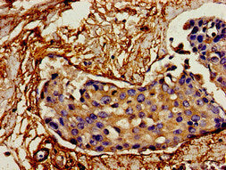 Immunohistochemistry of paraffin-embedded human breast cancer using CSB-PA16819A0Rb at dilution of 1:100