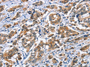 The image on the left is immunohistochemistry of paraffin-embedded Human breast cancer tissue using CSB-PA168224(CRABP2 Antibody) at dilution 1/20, on the right is treated with fusion protein. (Original magnification: ×200)