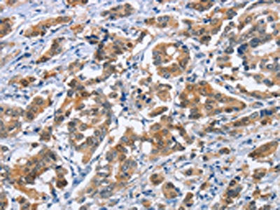 The image on the left is immunohistochemistry of paraffin-embedded Human breast cancer tissue using CSB-PA168224(CRABP2 Antibody) at dilution 1/20, on the right is treated with fusion protein. (Original magnification: ×200)