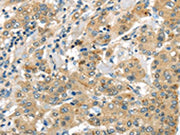 The image on the left is immunohistochemistry of paraffin-embedded Human liver cancer tissue using CSB-PA168712(UTS2B Antibody) at dilution 1/35, on the right is treated with synthetic peptide. (Original magnification: ×200)