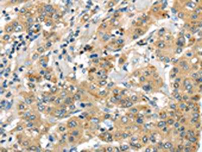 The image on the left is immunohistochemistry of paraffin-embedded Human liver cancer tissue using CSB-PA168712(UTS2B Antibody) at dilution 1/35, on the right is treated with synthetic peptide. (Original magnification: ×200)