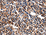 The image on the left is immunohistochemistry of paraffin-embedded Human breast cancer tissue using CSB-PA168758(LGALS3 Antibody) at dilution 1/5, on the right is treated with fusion protein. (Original magnification: ×200)