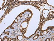 The image on the left is immunohistochemistry of paraffin-embedded Human thyroid cancer tissue using CSB-PA168936(CXCR3 Antibody) at dilution 1/20, on the right is treated with synthetic peptide. (Original magnification: ×200)