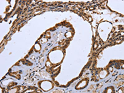 The image on the left is immunohistochemistry of paraffin-embedded Human thyroid cancer tissue using CSB-PA168936(CXCR3 Antibody) at dilution 1/20, on the right is treated with synthetic peptide. (Original magnification: ×200)