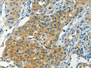The image on the left is immunohistochemistry of paraffin-embedded Human liver cancer tissue using CSB-PA168970(CHRNA2 Antibody) at dilution 1/30, on the right is treated with synthetic peptide. (Original magnification: ×200)