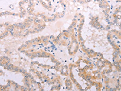 The image on the left is immunohistochemistry of paraffin-embedded Human thyroid cancer tissue using CSB-PA169016(TPO Antibody) at dilution 1/50, on the right is treated with fusion protein. (Original magnification: ×200)