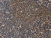 The image on the left is immunohistochemistry of paraffin-embedded Human lymphoma tissue using CSB-PA169208(STRADB Antibody) at dilution 1/20, on the right is treated with fusion protein. (Original magnification: ×200)