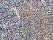 The image on the left is immunohistochemistry of paraffin-embedded Human Lymphoma tissue using CSB-PA169235(CCL16 Antibody) at dilution 1/50, on the right is treated with synthetic peptide. (Original magnification: ×200)