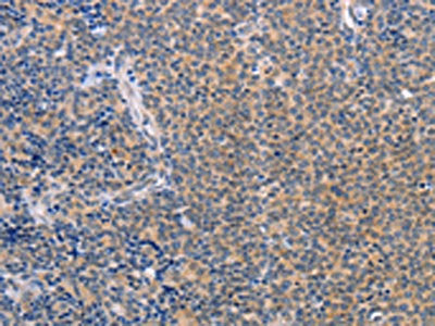 The image on the left is immunohistochemistry of paraffin-embedded Human Lymphoma tissue using CSB-PA169235(CCL16 Antibody) at dilution 1/50, on the right is treated with synthetic peptide. (Original magnification: ×200)