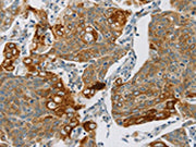 The image on the left is immunohistochemistry of paraffin-embedded Human cervical cancer tissue using CSB-PA169309(SMOC2 Antibody) at dilution 1/30, on the right is treated with synthetic peptide. (Original magnification: ×200)