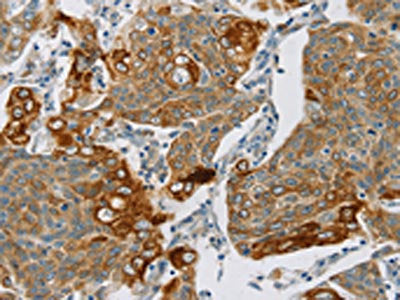 The image on the left is immunohistochemistry of paraffin-embedded Human cervical cancer tissue using CSB-PA169309(SMOC2 Antibody) at dilution 1/30, on the right is treated with synthetic peptide. (Original magnification: ×200)
