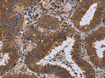The image on the left is immunohistochemistry of paraffin-embedded Human colon cancer tissue using CSB-PA169583(NPTX1 Antibody) at dilution 1/50, on the right is treated with synthetic peptide. (Original magnification: ×200)