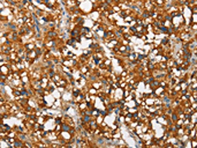 The image on the left is immunohistochemistry of paraffin-embedded Human thyroid cancer tissue using CSB-PA169656(SNCA Antibody) at dilution 1/60, on the right is treated with synthetic peptide. (Original magnification: ×200)