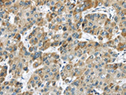 The image on the left is immunohistochemistry of paraffin-embedded Human liver cancer tissue using CSB-PA169699(CHRNA1 Antibody) at dilution 1/20, on the right is treated with synthetic peptide. (Original magnification: ×200)