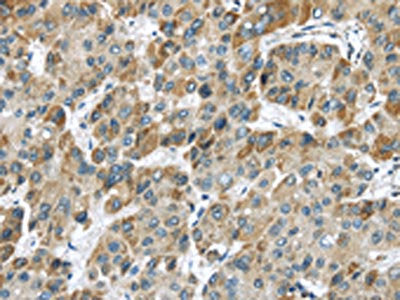 The image on the left is immunohistochemistry of paraffin-embedded Human liver cancer tissue using CSB-PA169699(CHRNA1 Antibody) at dilution 1/20, on the right is treated with synthetic peptide. (Original magnification: ×200)