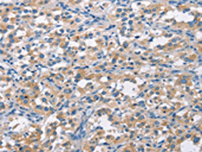 The image on the left is immunohistochemistry of paraffin-embedded Human thyroid cancer tissue using CSB-PA169739(CDC25B Antibody) at dilution 1/50, on the right is treated with synthetic peptide. (Original magnification: ×200)
