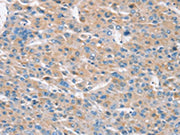 The image on the left is immunohistochemistry of paraffin-embedded Human liver cancer tissue using CSB-PA169782(RASA3 Antibody) at dilution 1/30, on the right is treated with synthetic peptide. (Original magnification: ×200)