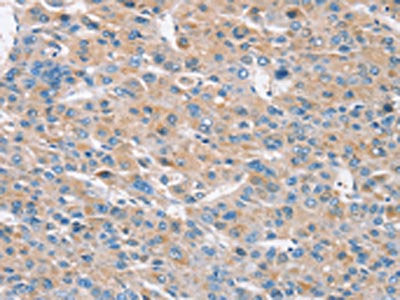 The image on the left is immunohistochemistry of paraffin-embedded Human liver cancer tissue using CSB-PA169782(RASA3 Antibody) at dilution 1/30, on the right is treated with synthetic peptide. (Original magnification: ×200)