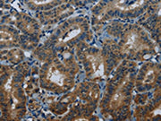 The image on the left is immunohistochemistry of paraffin-embedded Human thyroid cancer tissue using CSB-PA169796(MEI1 Antibody) at dilution 1/20, on the right is treated with fusion protein. (Original magnification: ×200)