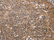 The image on the left is immunohistochemistry of paraffin-embedded Human cervical cancer tissue using CSB-PA170130(ERCC6L Antibody) at dilution 1/30, on the right is treated with fusion protein. (Original magnification: ×200)